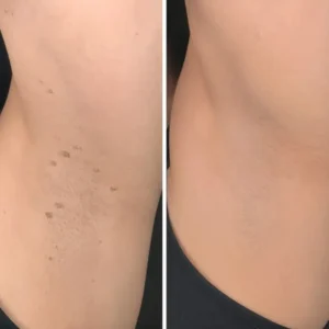 🎉🎉𝐇𝐢𝐬𝐤𝐢𝐧® 2-in-1 Microneedle & Hydrocolloid Patch | Removes raised moles, acne, flat warts, and skin tags | Helps improve wrinkles, scars, and blemishes | Invisible patches for face and body
