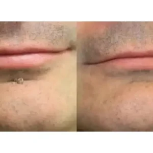 🎉🎉𝐇𝐢𝐬𝐤𝐢𝐧® 2-in-1 Microneedle & Hydrocolloid Patch | Removes raised moles, acne, flat warts, and skin tags | Helps improve wrinkles, scars, and blemishes | Invisible patches for face and body