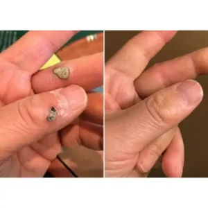 🎉🎉𝐇𝐢𝐬𝐤𝐢𝐧® 2-in-1 Microneedle & Hydrocolloid Patch | Removes raised moles, acne, flat warts, and skin tags | Helps improve wrinkles, scars, and blemishes | Invisible patches for face and body