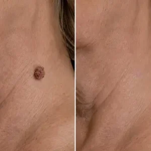 🎉🎉𝐇𝐢𝐬𝐤𝐢𝐧® 2-in-1 Microneedle & Hydrocolloid Patch | Removes raised moles, acne, flat warts, and skin tags | Helps improve wrinkles, scars, and blemishes | Invisible patches for face and body