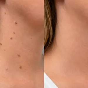 🎉🎉𝐇𝐢𝐬𝐤𝐢𝐧® 2-in-1 Microneedle & Hydrocolloid Patch | Removes raised moles, acne, flat warts, and skin tags | Helps improve wrinkles, scars, and blemishes | Invisible patches for face and body