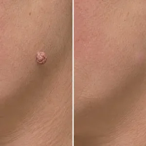🎉🎉𝐇𝐢𝐬𝐤𝐢𝐧® 2-in-1 Microneedle & Hydrocolloid Patch | Removes raised moles, acne, flat warts, and skin tags | Helps improve wrinkles, scars, and blemishes | Invisible patches for face and body