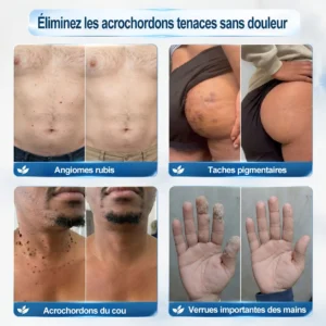 Stylo Roll-On HISKIN®
    Éliminateur d'Excroissances Cutanées & de Taches en 7 Jours
    Sans Douleur & Sans Cicatrice