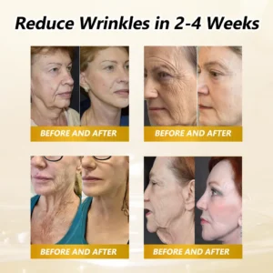 𝐇𝐈𝐒𝐊𝐈𝐍® BEE VENOM BIO-REVIVE BODY ROLLER
 – 𝐇𝐢𝐒𝐤𝐢𝐧