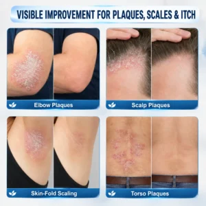 𝐇𝐈𝐒𝐊𝐈𝐍® 👩‍⚕️Calming Care for Psoriasis-Prone Skin |7-Day Soothing Roll
 –  HISKIN®  Official Store