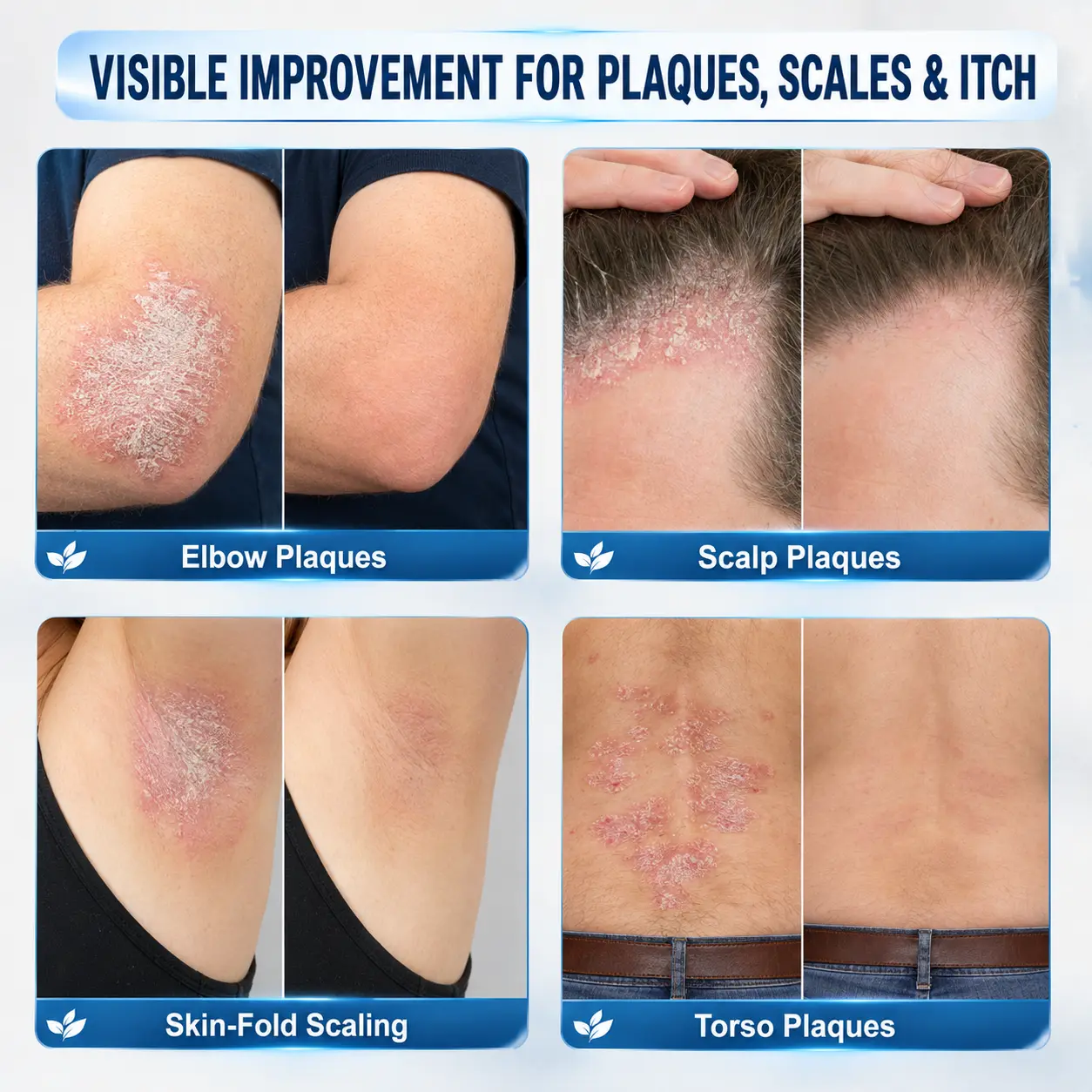 𝐇𝐈𝐒𝐊𝐈𝐍® 👩⚕️Calming Care for Psoriasis-Prone Skin |7-Day Soothing Roll
– HISKIN® Official Store