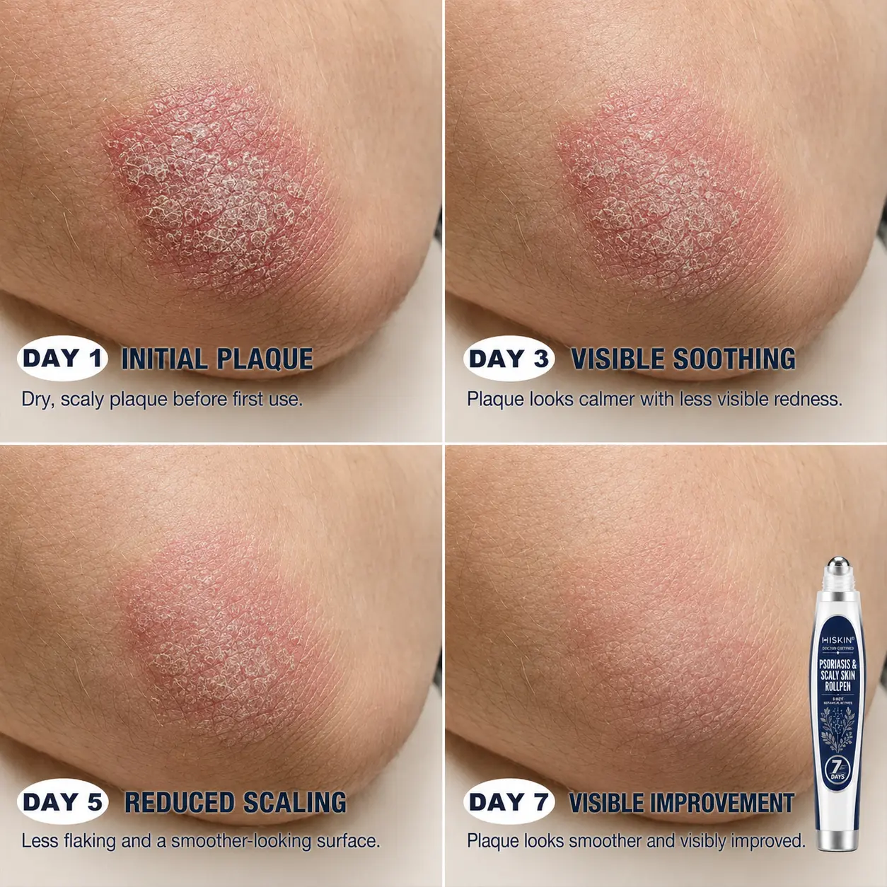 𝐇𝐈𝐒𝐊𝐈𝐍® 👩⚕️Calming Care for Psoriasis-Prone Skin |7-Day Soothing Roll
– HISKIN® Official Store