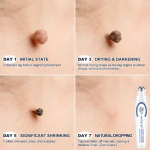 HISKIN®
Advanced Wart Removal Pen