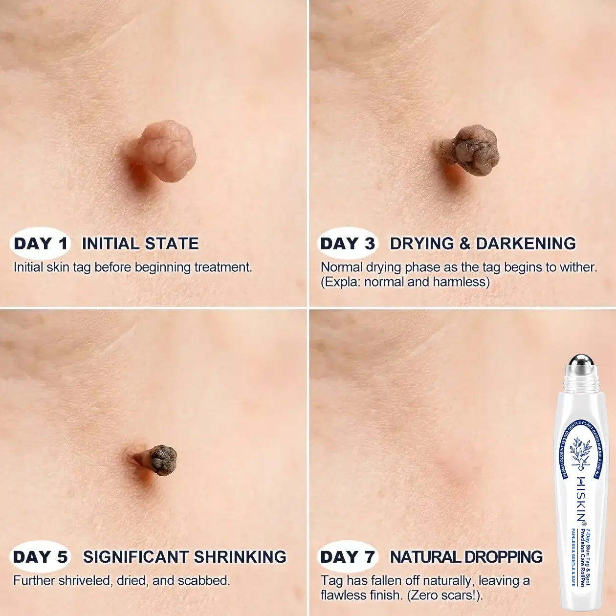 HISKIN®
Advanced Wart Removal Pen
